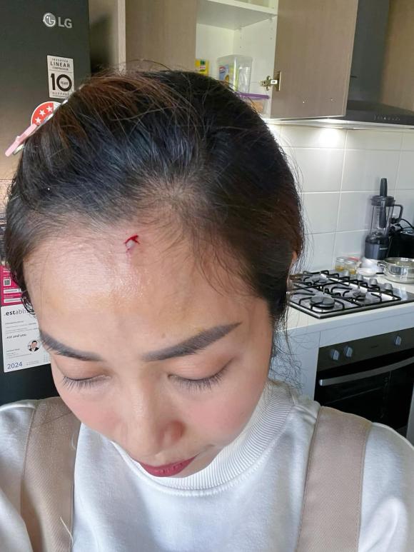 Ốc Thanh Vân bị sự cố chảy máu trán.