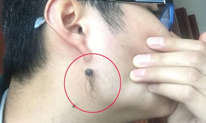 Dù bạn là nam hay nữ, việc sở hữu nốt ruồi có lông mọc được xem là điềm báo tốt lành
