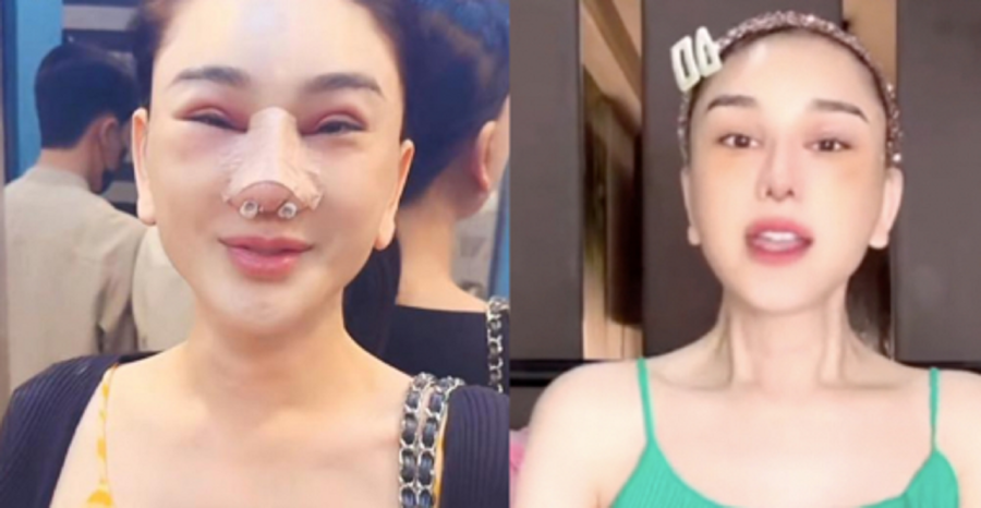 Lâm Khánh Chi sửa mũi lần 3 để cải thiện nhan sắc    