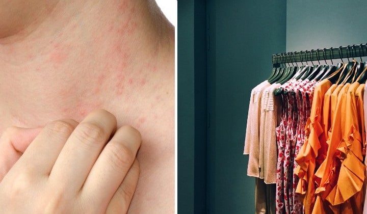 Khi da tiếp xúc với các chất nhuộm và chống nhăn ở quần áo mới sẽ rất dễ bị kích ứng và gặp các biểu hiện như tấy đỏ, ngứa rát hoặc tạo vảy... 