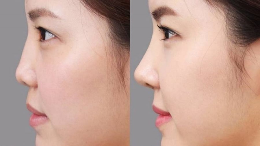 Các cách Shbet888 tiền thưởng cực khủng nâng mũi hiện nay