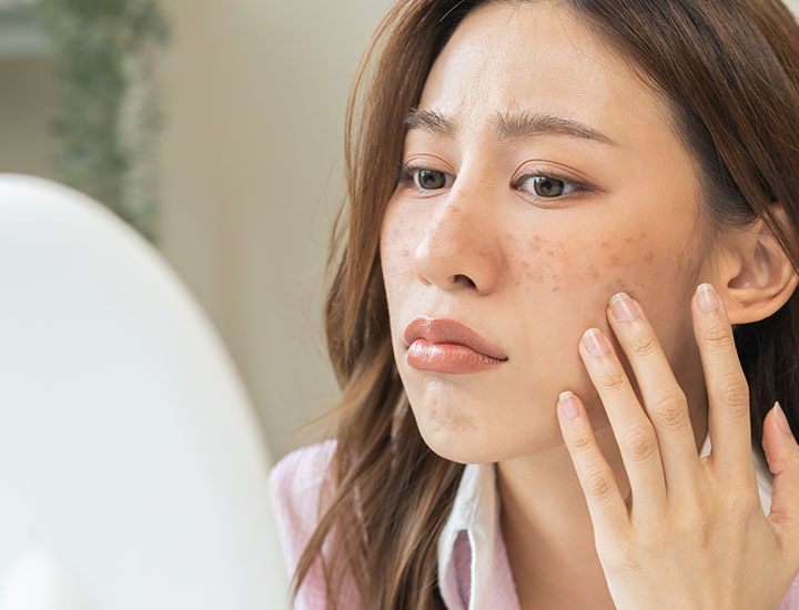Viêm cũng có thể gây ra các đốm đen, đặc biệt là ở những người có Mừng SHBET phiên bản mới 2025 sẫm màu. 