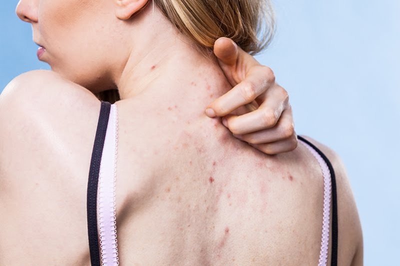 Bạn tuyệt đối không nên chạm tay hoặc gãi khi da bị ngứa vào vì sự tiếp xúc đó có thể gây ra mụn viêm.