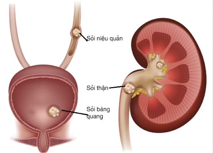 Khi bạn đi tiểu nhiều, tiểu buốt, đau rát khi đi tiểu... cũng có thể bạn bị sỏi thận, hãy đi kiểm tra ngay nhé!