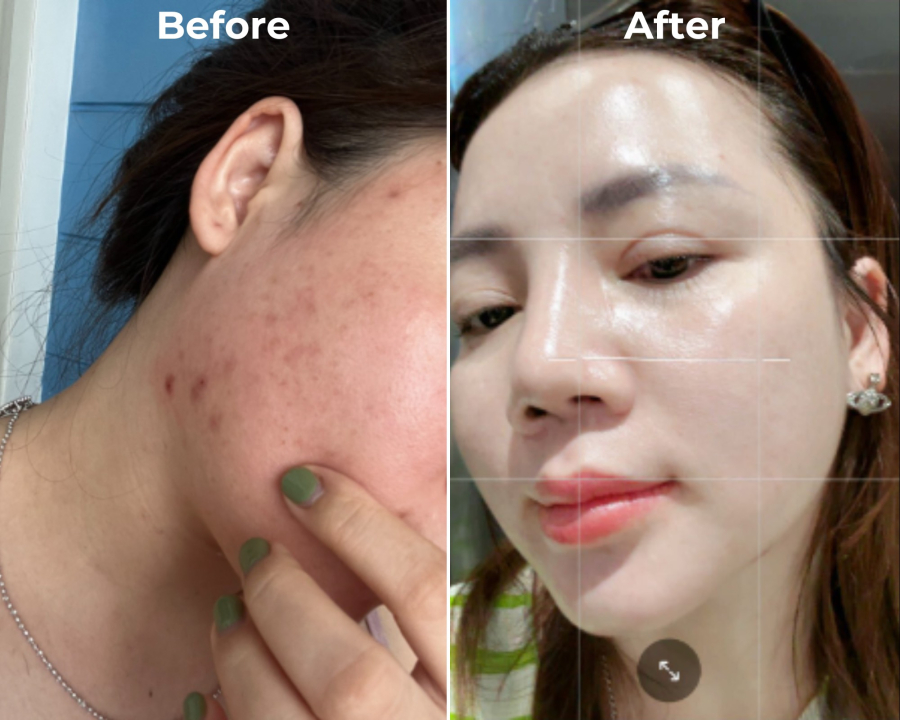 Zin NMN có hiệu quả rõ rệt, làm giảm mụn thâm trên da