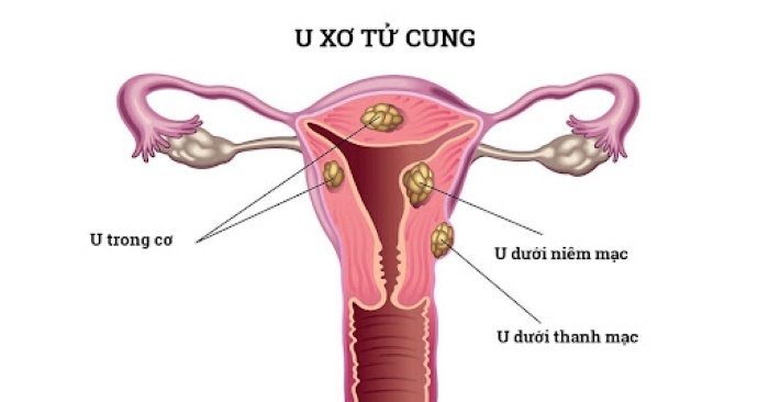 Nguyên nhân chính xác gây u xơ tử cung chưa rõ ràng