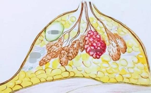 Mặc dù hầu hết các u nang vú lành tính, nhưng cũng có thể là dấu hiệu sớm của ung thư vú.