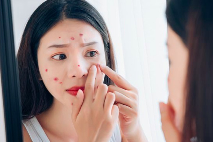 Sữa được biết có khả năng làm tăng nồng độ insulin, có thể làm trầm trọng thêm tình trạng mụn.