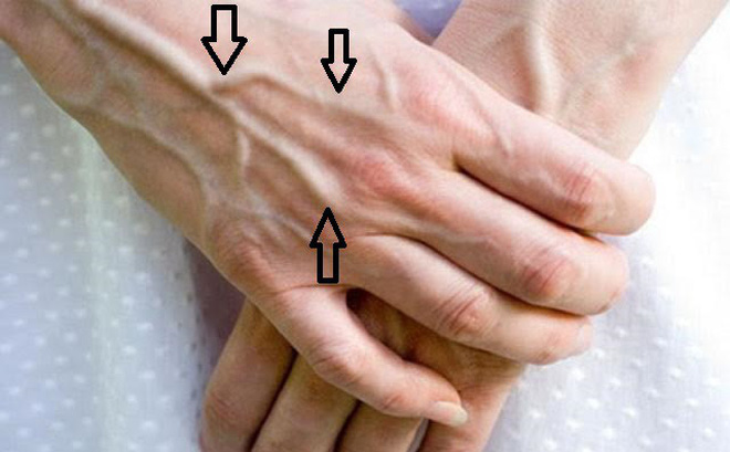 Nếu gân tay đột nhiên thay đổi, màu sắc đậm hơn, kích thước lớn hơn và nổi rõ hơn trên da tay nhiều so với trước, bạn nên đi khám sức khỏe
