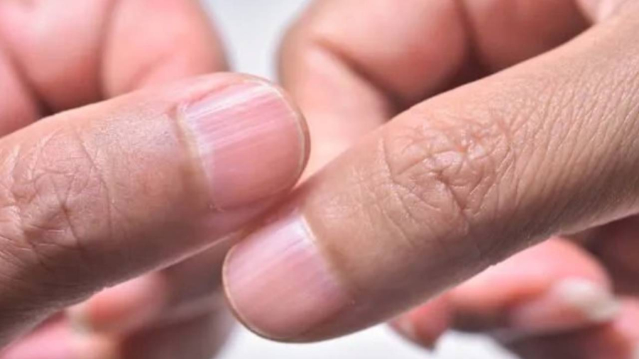 Ở người khỏe mạnh, móng tay thường có màu hồng nhạt