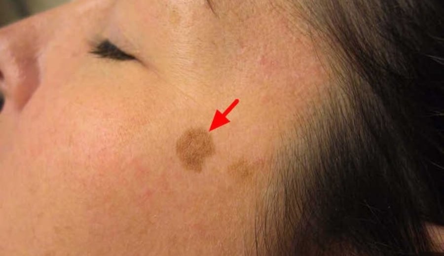 Muốn loại bỏ các vết đồi mồi trên khuôn mặt, bạn cần phải nắm vững 6 phương pháp này để làm cho khuôn mặt trông sáng hơn, trắng và sạch hơn.