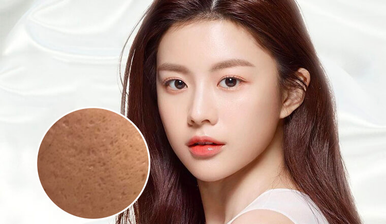  Các trường hợp mụn viêm nhiễm nặng vẫn gây ra sẹo rỗ, ngay cả khi để mụn tự lành.