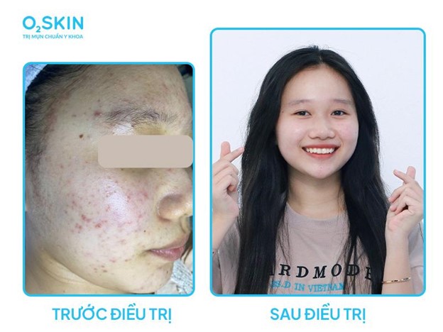 Làn da mịn màng, sạch mụn của Thảo sau khi điều trị tại O2 SKIN.