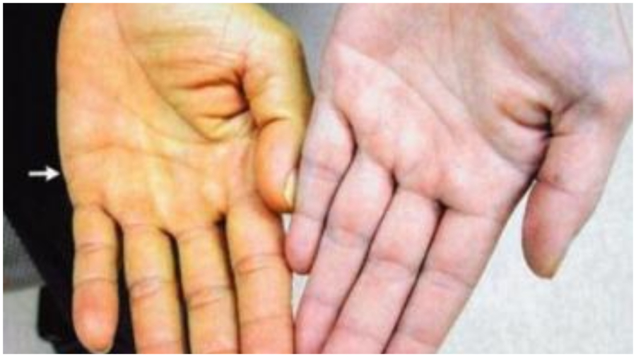 Vàng da cảnh báo bệnh gan đã đi vào giai đoạn nặng nên đi khám