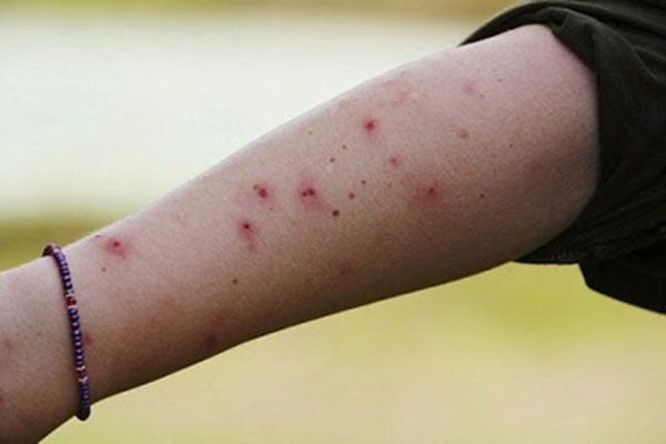 Mẹo đơn giản giúp giảm ngứa cực nhanh khi bị muỗi và côn trùng đốt 