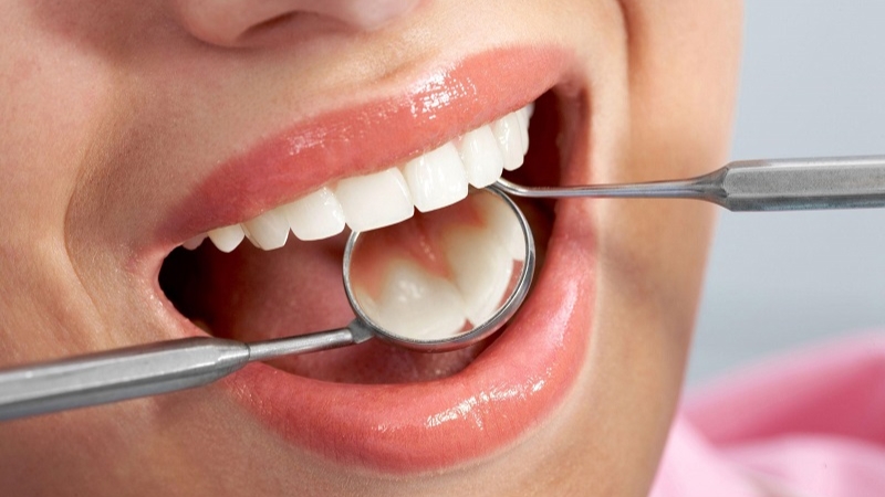  Nếu không vệ sinh răng miệng đúng cách, cao răng có thể tích tụ trên răng và dẫn đến bệnh nướu răng