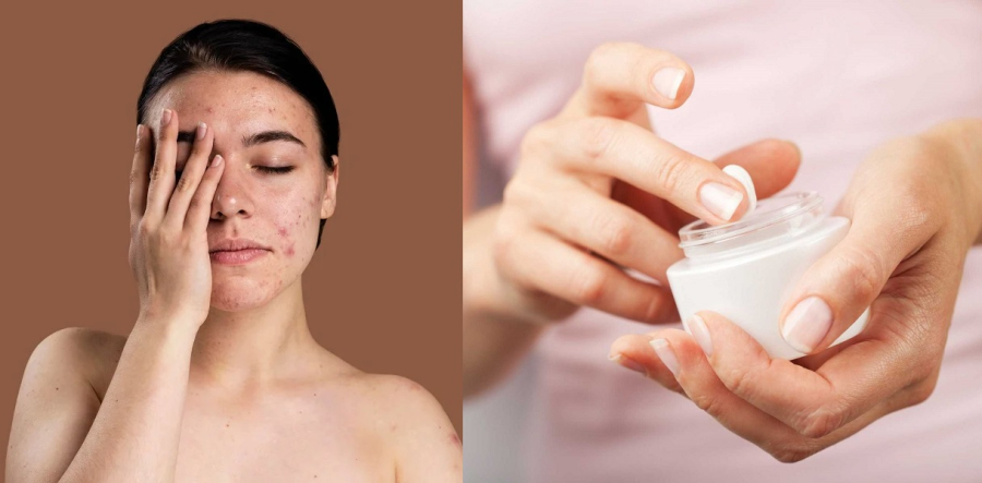 Các loại vi khuẩn không chỉ khiến da bị viêm & nhiễm trùng, nổi mụn trứng cá mất kiểm soát mà còn ảnh hưởng đến các bộ phận khác trên Sh88bet đăng ký miễn phí