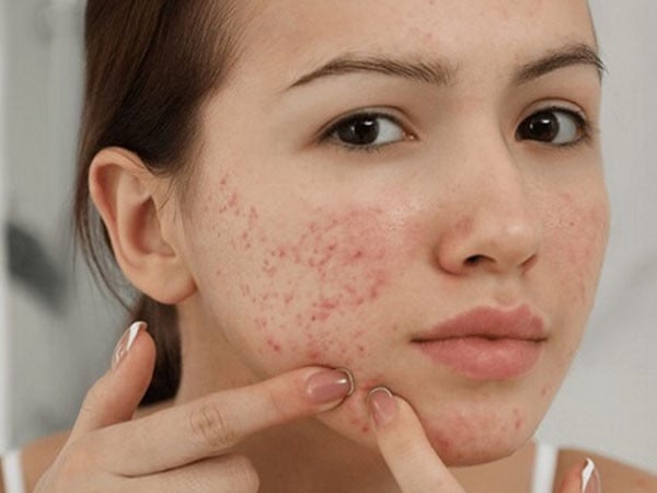 Việc sử dụng các sản phẩm bôi trước và sau khi tẩy lông mặt có thể gây tắc lỗ chân lông, dẫn đến mụn. 