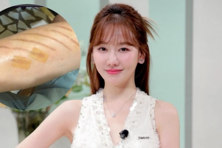 Hari Won tiết lộ tình trạng hiện tại sau khi bị ngã cầu thang cuốn  