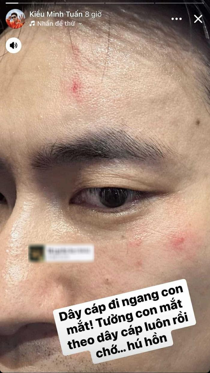 Vết thương nằm ngay dưới mắt trái của anh, chỉ cần một chút là có thể gây ra tình trạng nghiêm trọng. 