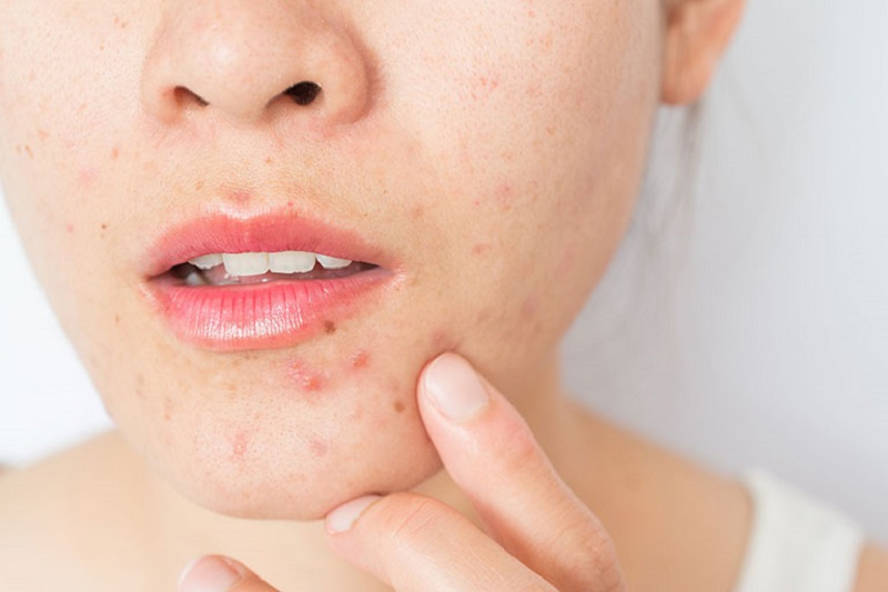 Để giảm thiểu vấn đề này, việc sử dụng tranexamic acid kết hợp với retinol sẽ mang lại hiệu quả rõ rệt.