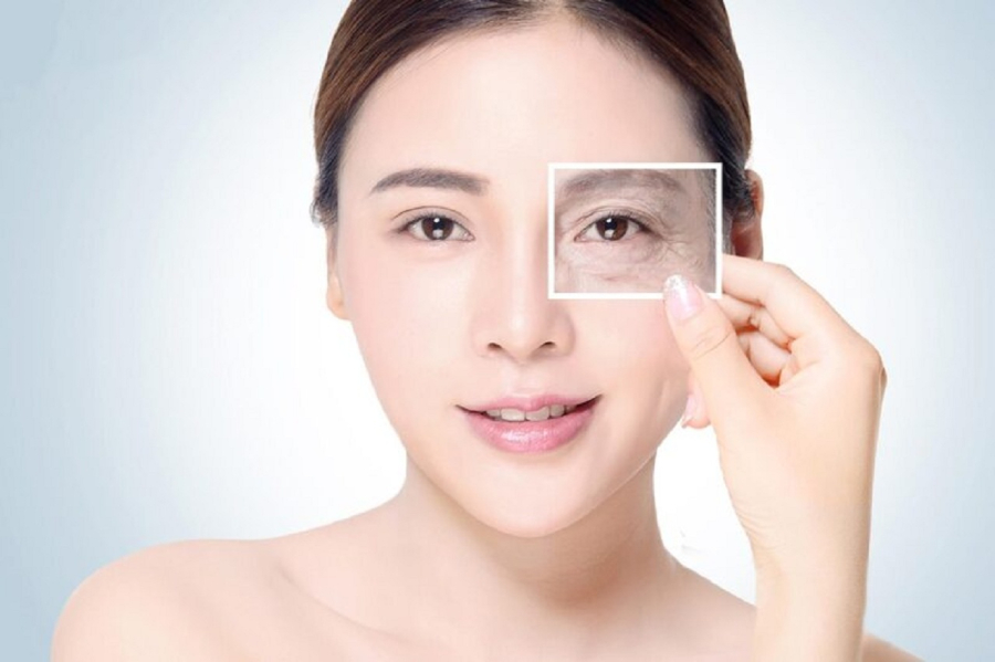 Nếp nhăn đuôi mắt – hay còn gọi là vết chân chim – là một trong những dấu hiệu lão hóa dễ nhận thấy nhất trên khuôn mặt.