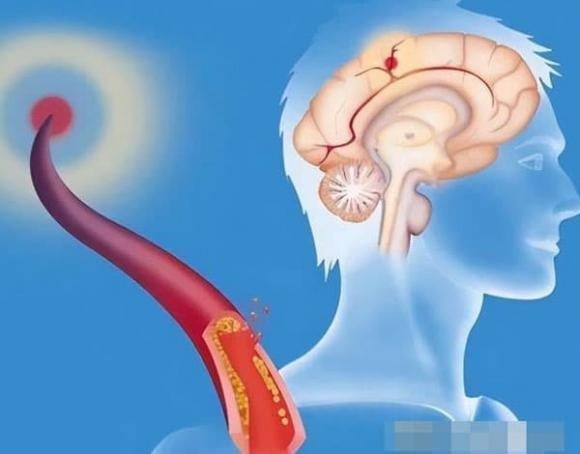 Đây là dấu hiệu phổ biến nhất và thường đi kèm với cảm giác đau dữ dội do tình trạng thiếu máu não nghiêm trọng. 