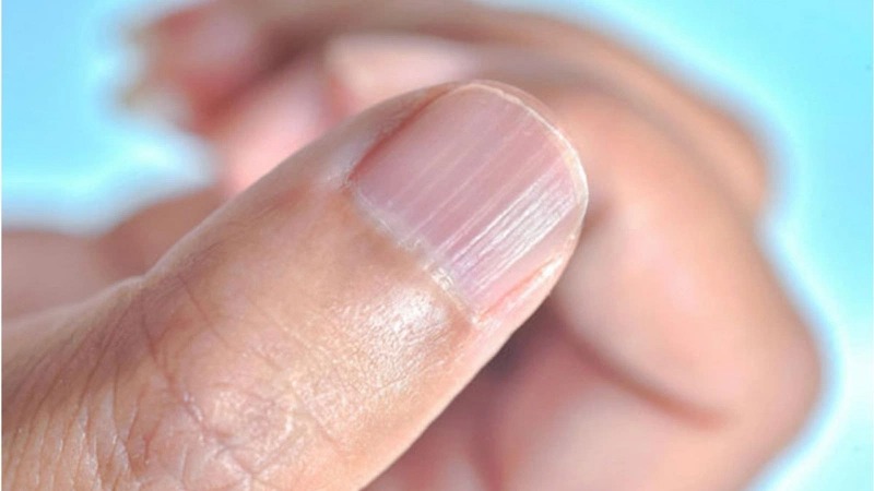 Một số người có đường sọc dọc trên móng tay từ khi còn nhỏ do yếu tố di truyền. 