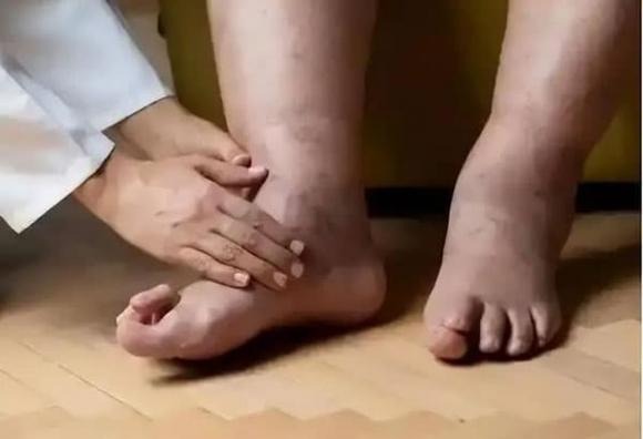 Nhiều người cho rằng đau chân về đêm là do vận động quá sức ban ngày, nhưng nếu tình trạng này xảy ra thường xuyên kèm theo chuột rút hoặc co giật bắp chân, đó có thể là dấu hiệu của huyết khối tĩnh mạch sâu.