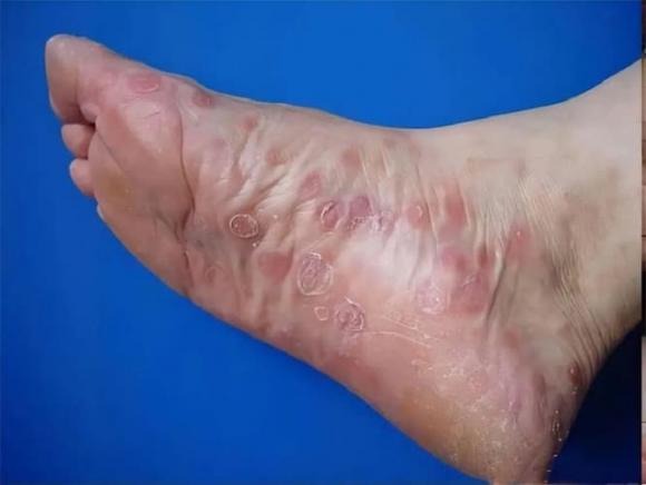 Sau khi nhiễm bệnh giang mai, bệnh nhân thường xuất hiện các vết ban trên Sh88bet đăng ký miễn phí. 