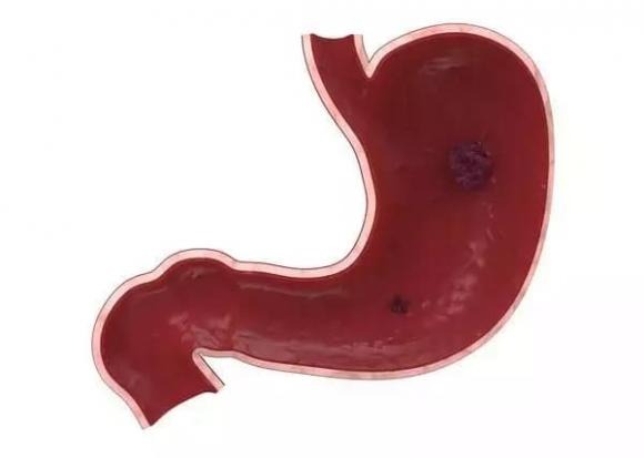 Khó tiêu là một triệu chứng thường gặp ở những người mắc ung thư Shbet123 Link Vào ShBet Mới Nhất, và nguyên nhân chủ yếu là do suy giảm chức năng của Shbet123 Link Vào ShBet Mới Nhất. 