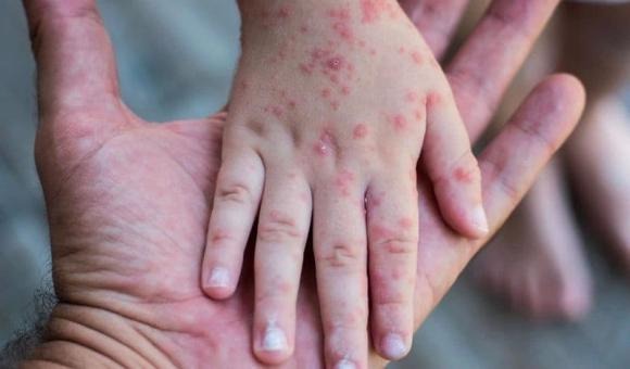 Sau khoảng 2-3 ngày, bệnh nhân sẽ xuất hiện các đốm trắng nhỏ trong miệng (dấu Koplik), đây là dấu hiệu đặc trưng giúp chẩn đoán sớm bệnh sởi.    