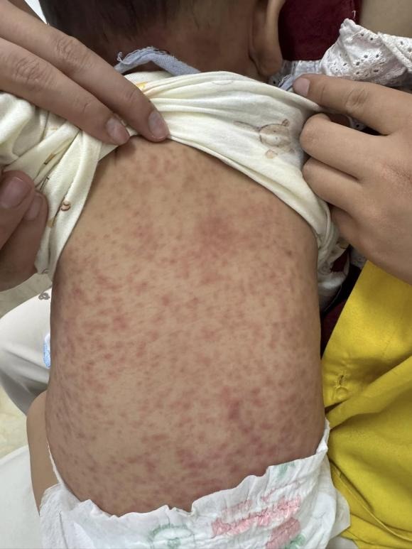 Bổ sung vitamin A trong suốt quá trình mắc bệnh sởi, theo hướng dẫn của bác sĩ.    