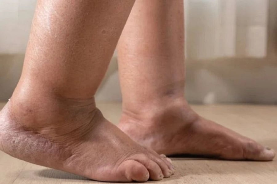Sưng chân là một trong những dấu hiệu quan trọng cảnh báo ung thư phổi giai đoạn cuối.