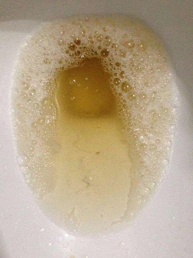 Một biểu hiện khác đáng lưu ý là nước tiểu có bọt, đặc biệt nếu bọt nhiều và lâu tan. 