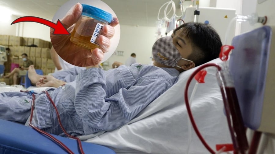 Thông thường, sau một đêm dài không ăn uống, nước tiểu đầu ngày của người khỏe mạnh sẽ có màu vàng đậm do nước tiểu bị cô đặc. 