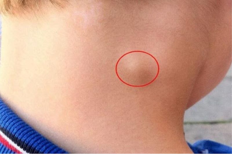 5 dấu hiệu ung thư hạch giai đoạn sớm, số 1 biểu hiện rất rõ ràng