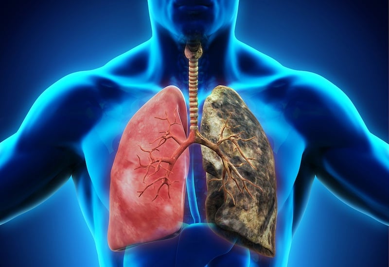 Cảnh báo: 8 dấu hiệu rõ ràng của ung thư phổi, đừng để tới khi di căn mới biết