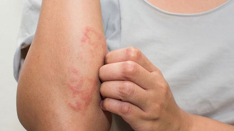 Ngứa da thường xuyên nguy cơ suy thận cao