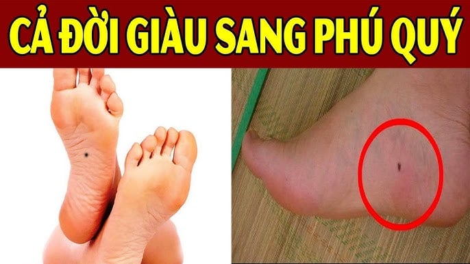 Nốt ruồi hút bạc tỷ ai có thật đáng chúc mừng
