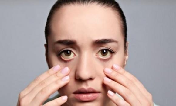 Vàng da là biểu hiện điển hình của tổn thương gan, xảy ra khi lượng bilirubin trong máu tăng cao. 