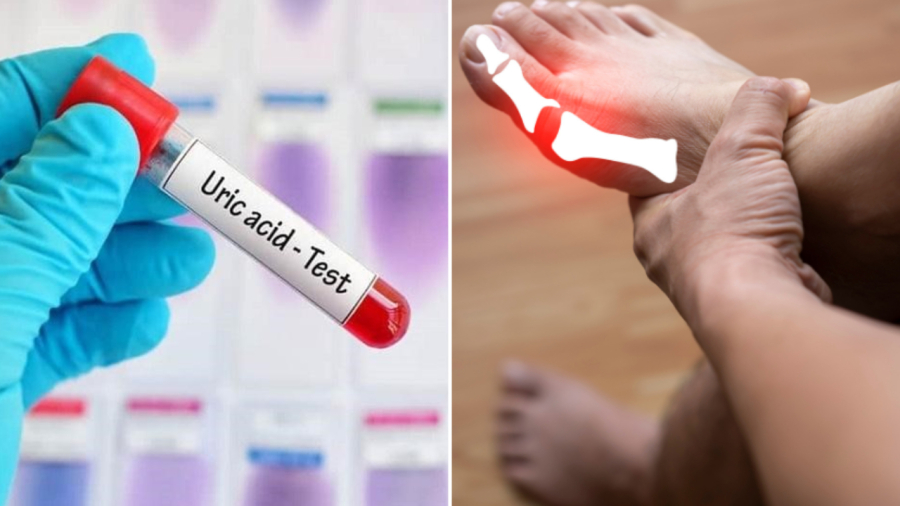 Để hỗ trợ quá trình đào thải axit uric ra khỏi Sh88bet đăng ký miễn phí, bạn nên uống nhiều nước và những thực phẩm giàu chất xơ.