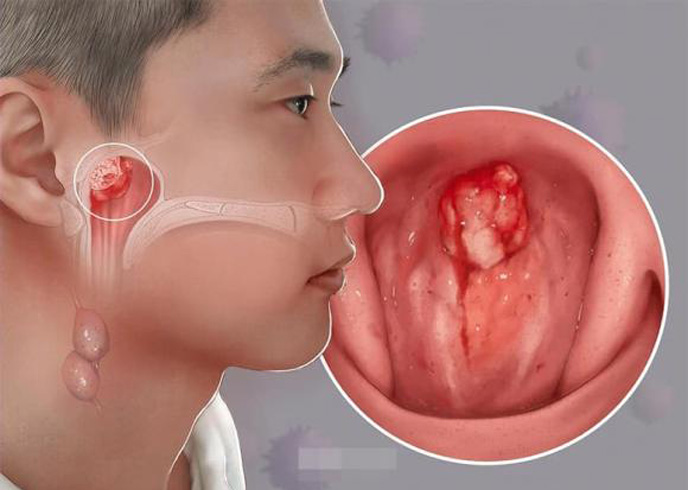 7 dấu hiệu K vòm họng: Số 1 không biết sớm khó mà chữa