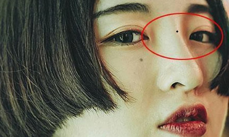 Nốt ruồi kém may mắn nên hóa giải