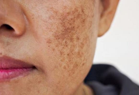 Da mặt trở nên tối, xỉn màu có thể do gan bị tổn thương từ bệnh gan mạn tính, xơ gan hoặc ung thư gan, khiến quá trình chuyển hóa melanin và bilirubin rối loạn, làm sắc tố da tích tụ.    