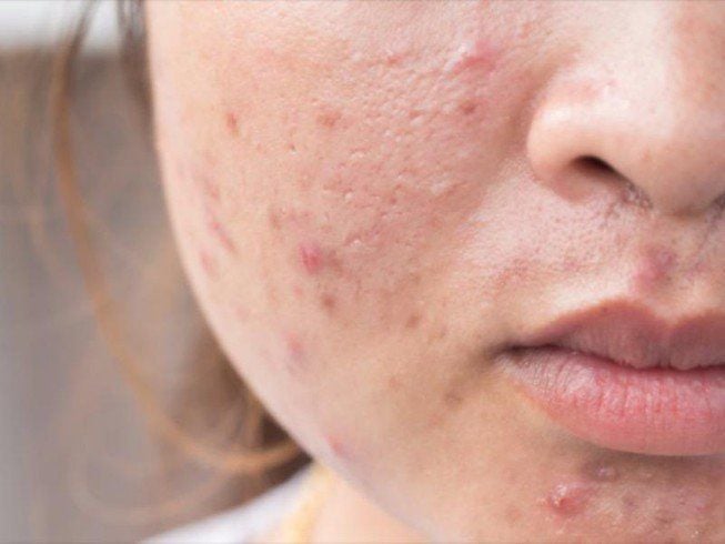 Khi không được làm sạch, lớp tinh chất thừa cùng với dầu nhờn tự nhiên của da sẽ bít kín lỗ chân lông. 