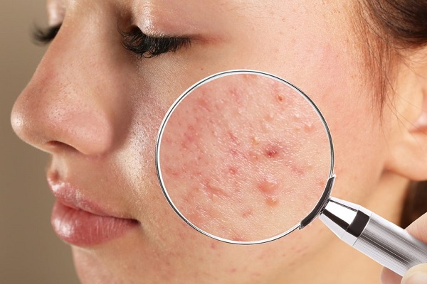 Có những giai đoạn, dù đã áp dụng đủ loại acid như BHA, AHA nhưng mụn ẩn vẫn không giảm. 