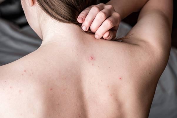 Mụn có thể chỉ xuất hiện ở vai, lưng trên hoặc lan rộng khắp lưng dưới nhiều dạng khác nhau 