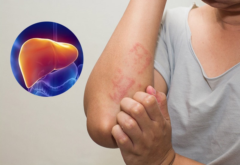 Cảnh báo bệnh gan nặng