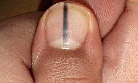 Một dải màu nâu, sẫm hoặc đen chạy dọc theo móng có thể là dấu hiệu của ung thư hắc tố da – dạng ung thư ác tính phát triển từ tế bào hắc tố dưới móng.    